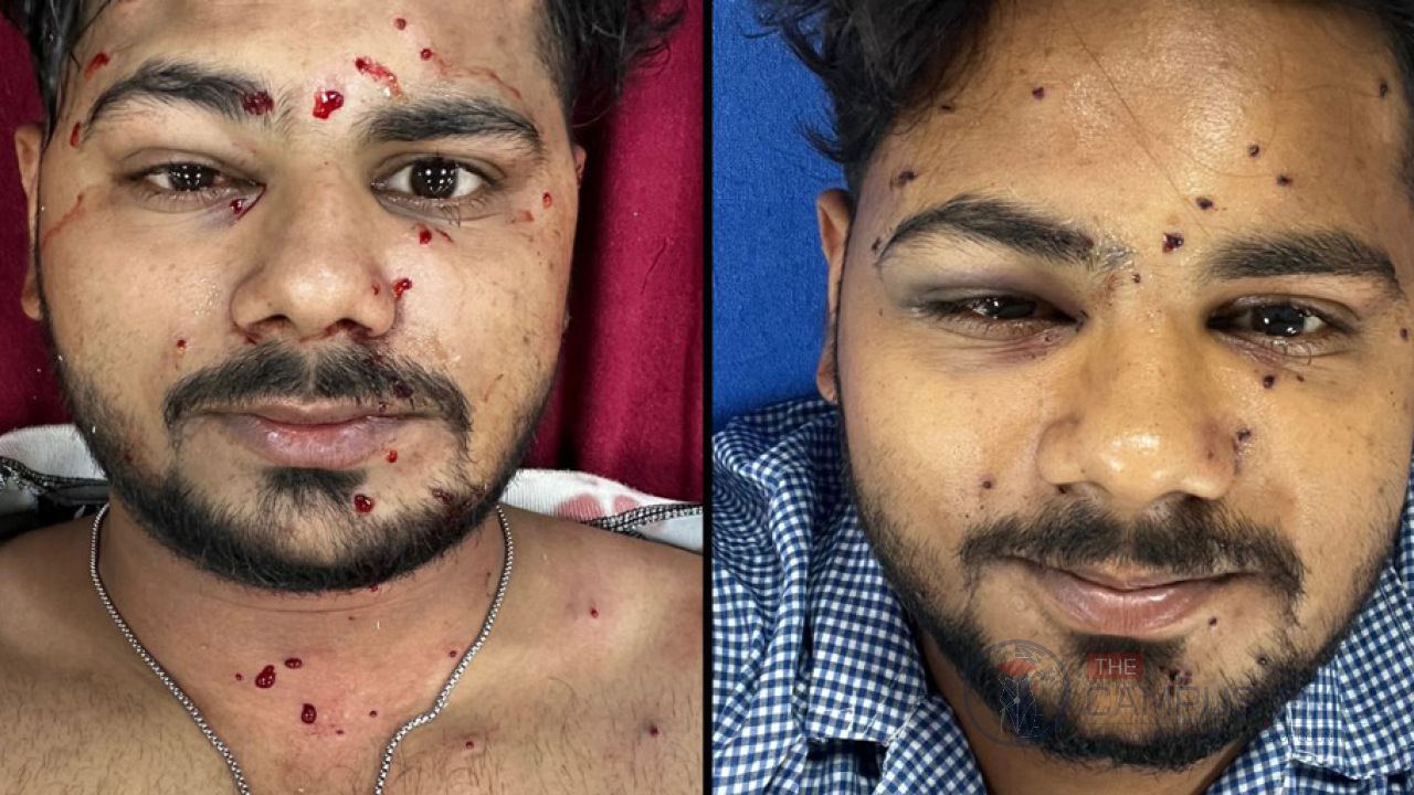 দিল্লিতে বিক্ষোভের সময় পেলেট গান ব্যবহারের অভিযোগ, আহত তরুণ